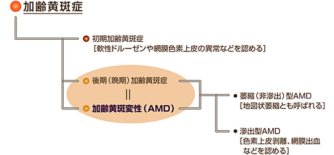 加齢黄斑症及び加齢黄斑変性（AMD）の分類概略の画像
